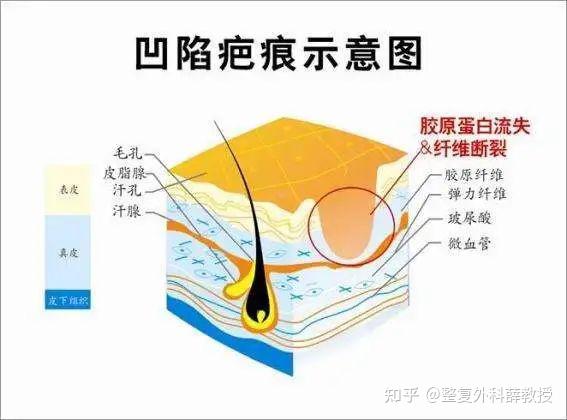多年的凹陷疤痕还能修复平整吗? - 知乎