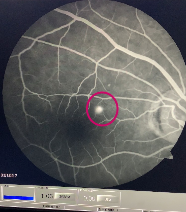 正常眼底荧光造影图片图片