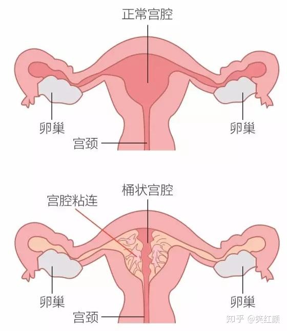 这几个症状暗示着你出现了宫腔粘连 宫腔粘连的白带的症状 帮果网