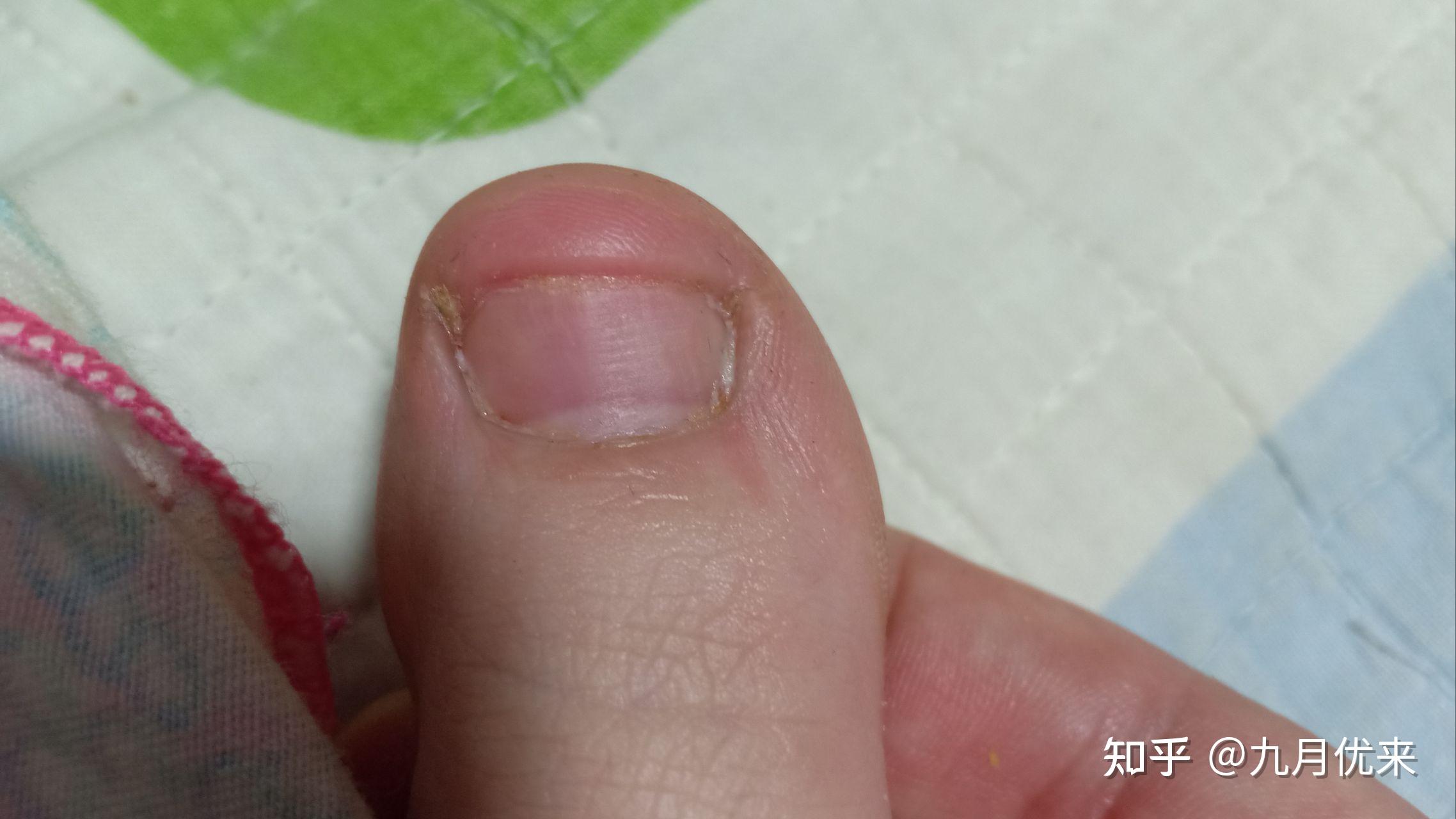 我用冰酸醋根治了6年的灰指甲,配合橡胶指套,3个月健康甲全部长出了