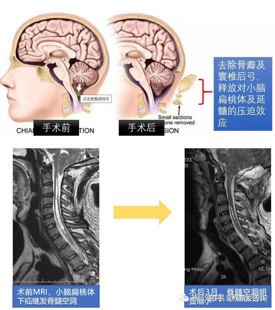 脊髓空洞病图片