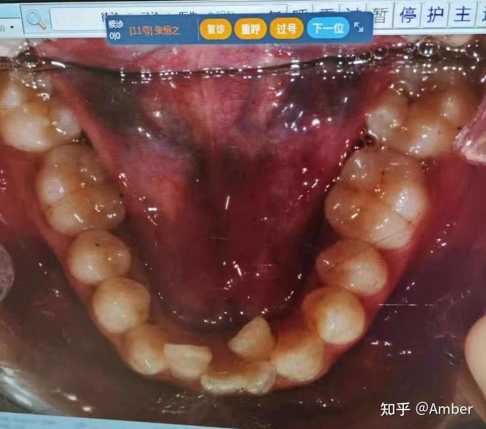 重度牙列拥挤加地包天正畸之旅