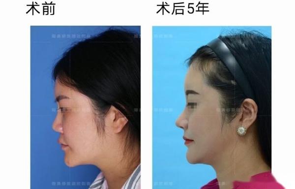 欧叔谈鼻:到底是假体还是肋软骨做鼻背好? - 知乎