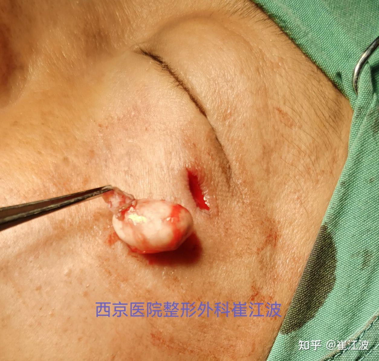皮脂腺囊肿手术图片图片