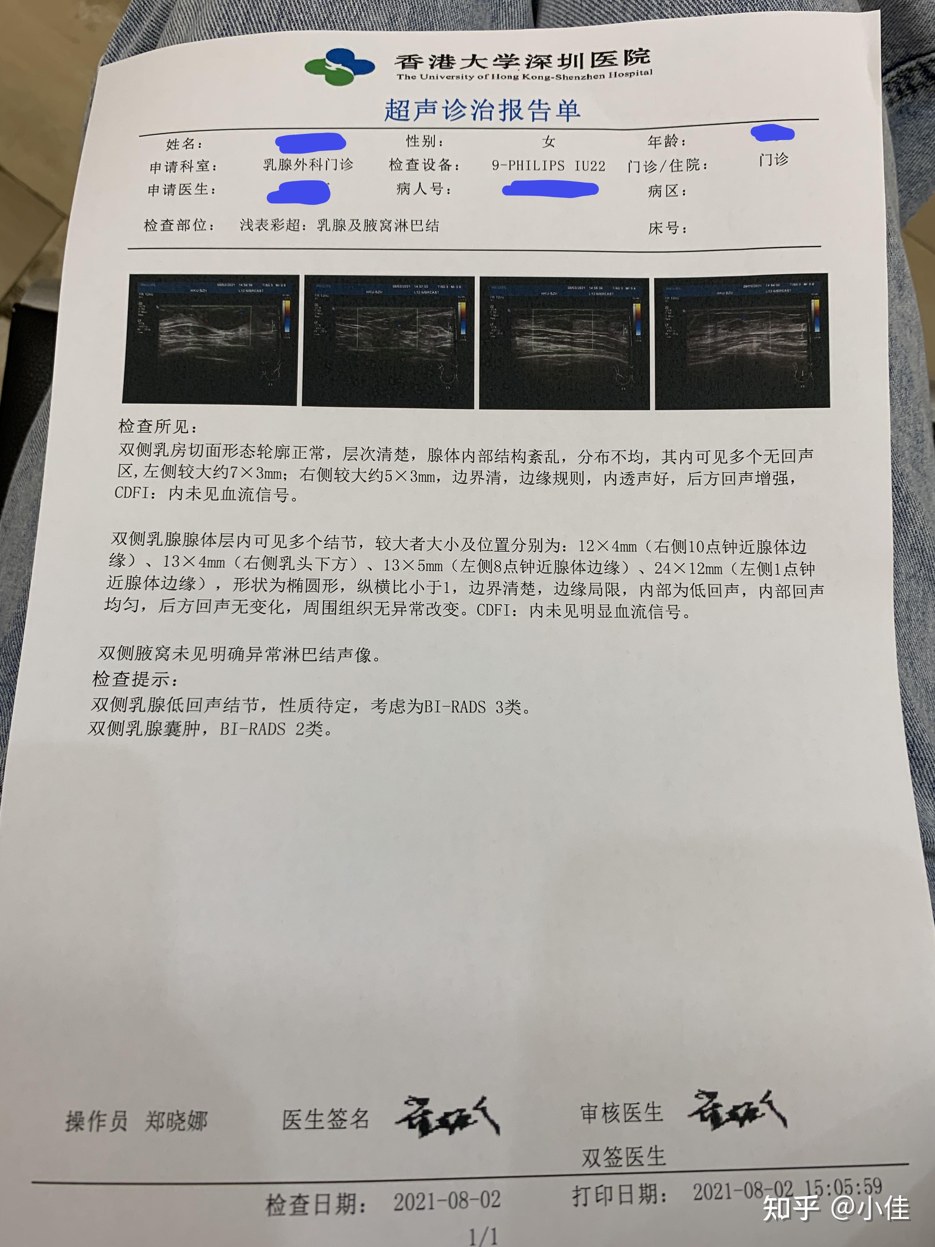 乳腺良性肿瘤纤维腺瘤手术过程及给姐妹们一些建议