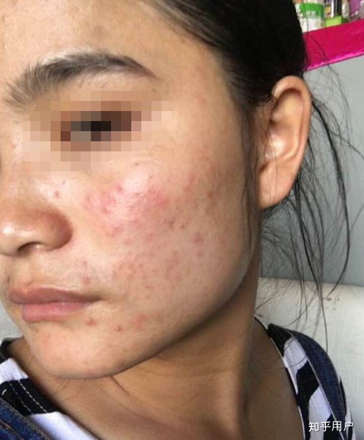 skii真的对痘痘肌肤有用吗