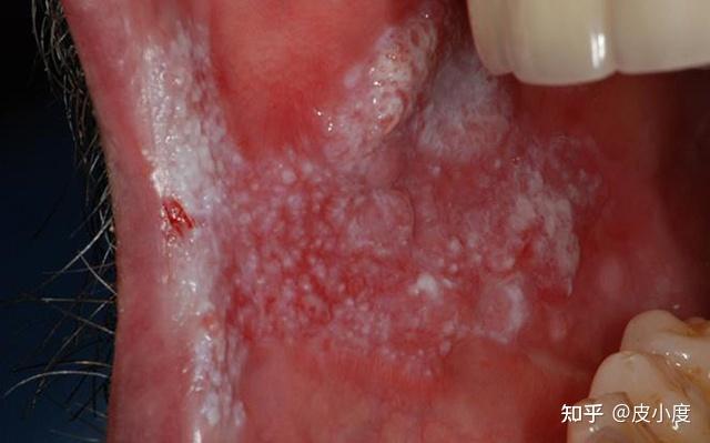 口腔黏膜白斑病图片