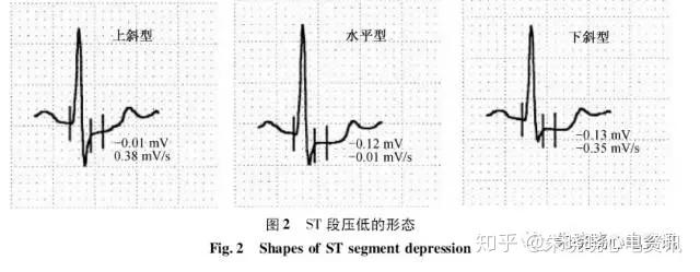 劉霞瑞金醫院20 世紀 30 年代, 心電圖應用於運動負荷試驗, 稱為運動