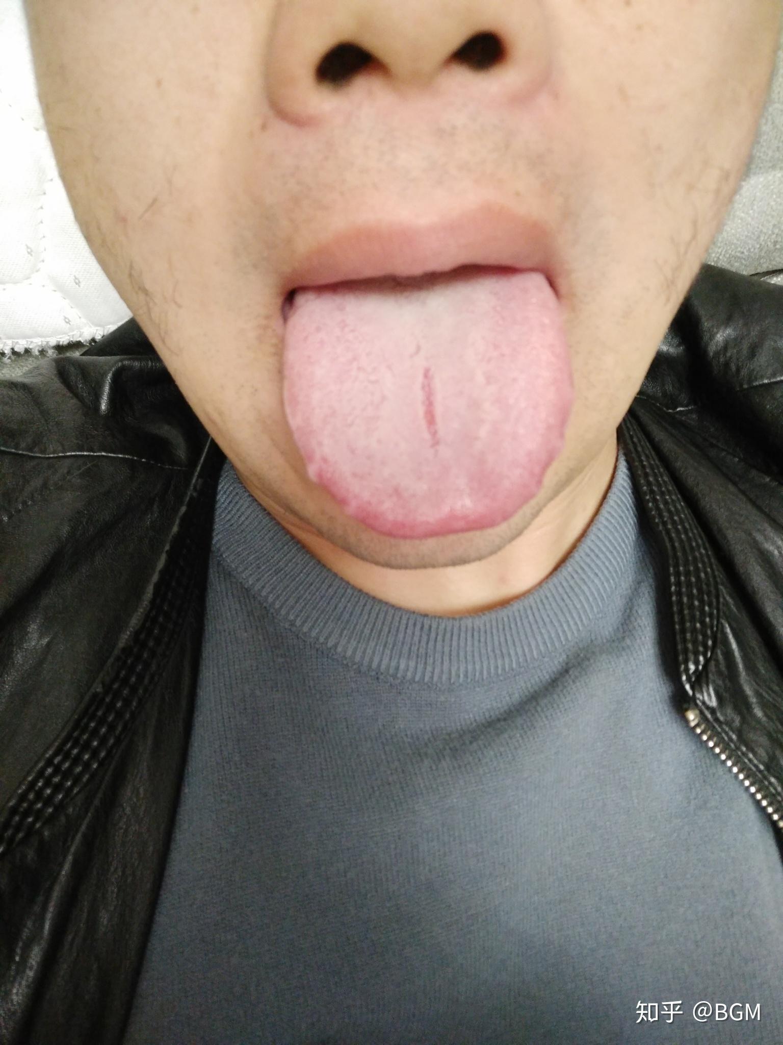 齿痕明显舌头前端中间有裂缝? 