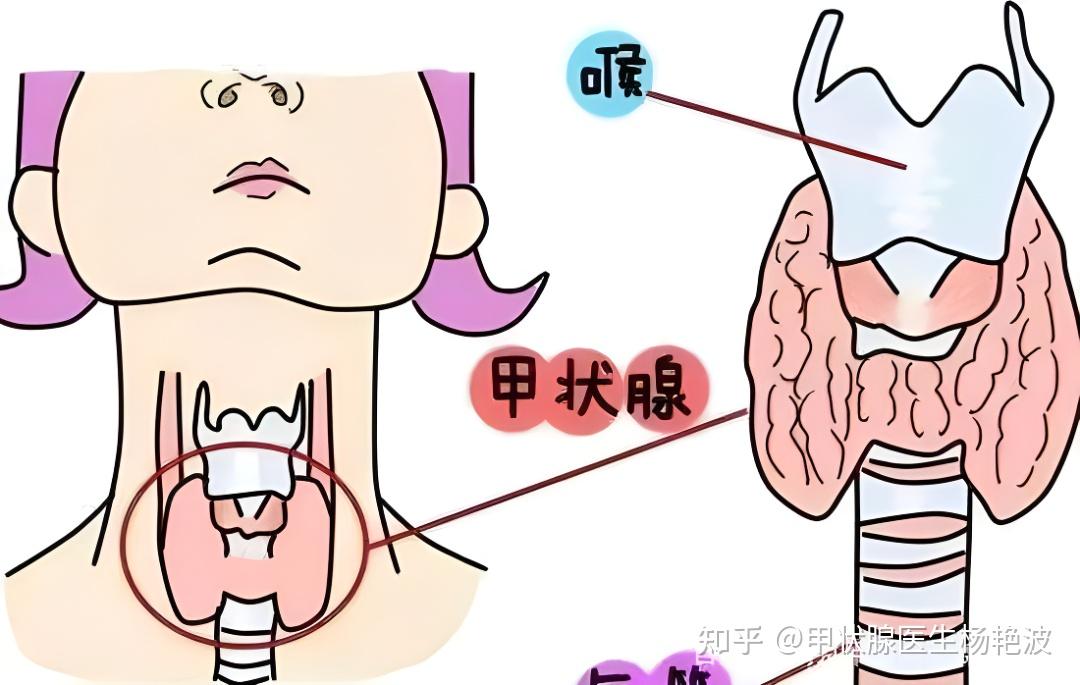 甲亢是什么?你想知道的都在这里,看这一篇就够了! - 知乎