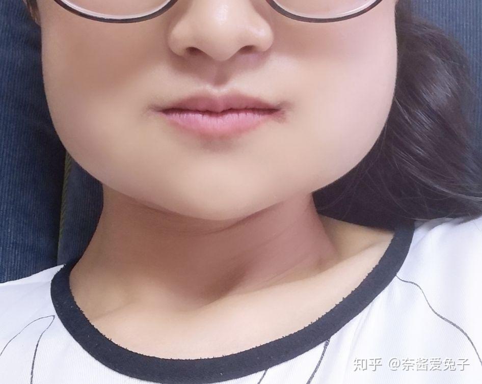 拔智齿脸肿? - 知乎