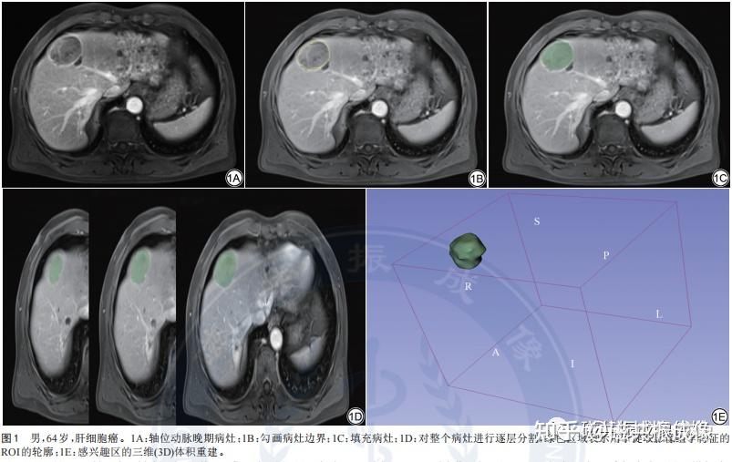 增強mr組學聯合臨床預測肝細胞癌根治性切除術後早期復發價值研究