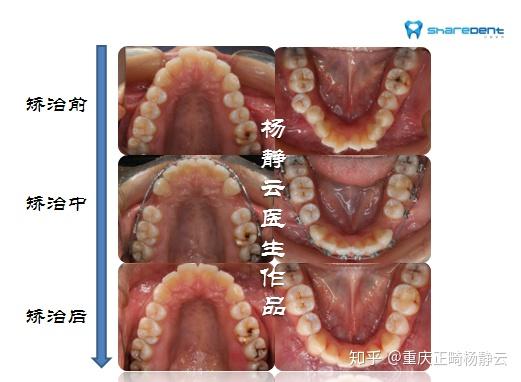 龅牙矫正案例分享7你们所谓的骨性与牙性
