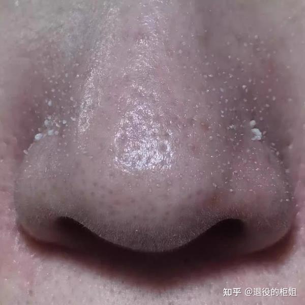 黑头上面还长出毛来该怎么办?毳毛型黑头是什么? - 知乎