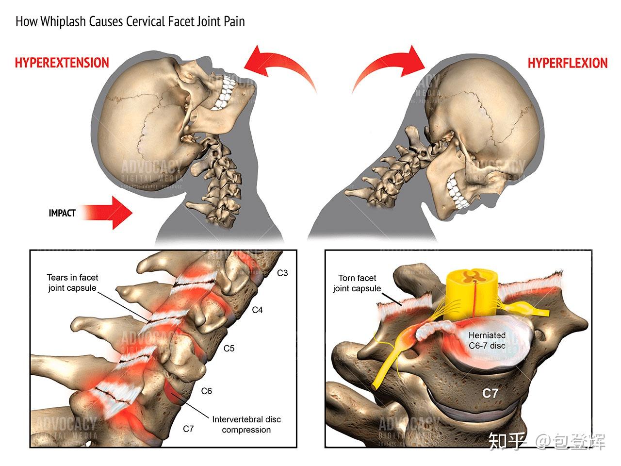 运动损伤系列挥鞭样损伤
