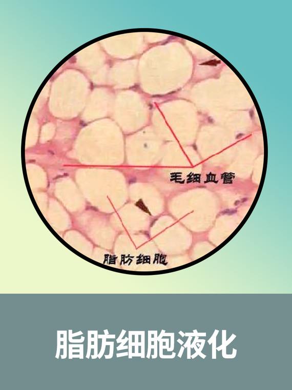 广州自体脂肪填充那些坑：自体脂肪填充后会移位吗？脂肪液化、钙化、团化是怎么回事 知乎 