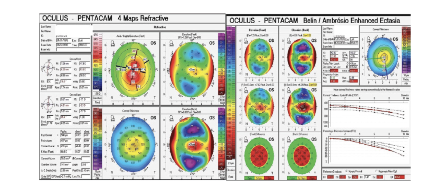 为什么超声角膜测厚检查怎么看角膜地形图呢？？_https://www.jmylbn.com_新闻资讯_第15张