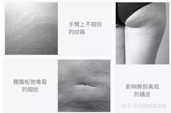 橘皮纹 - 知乎