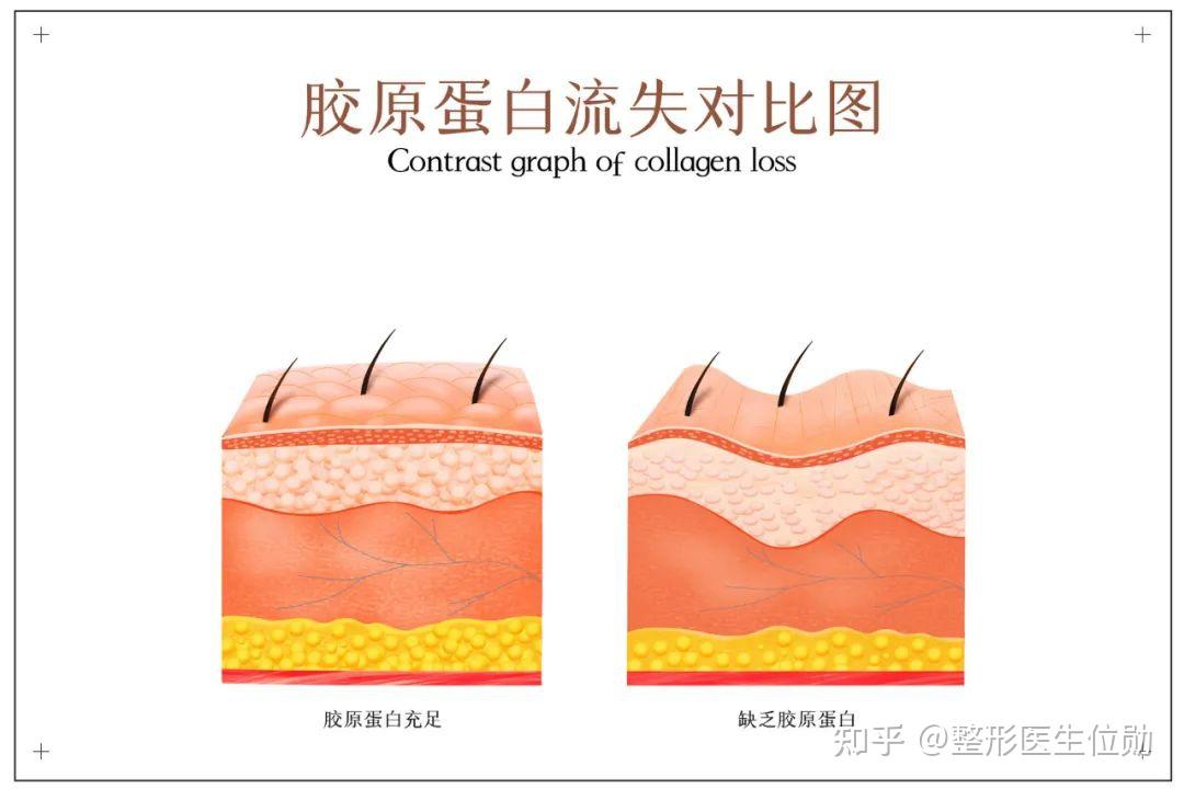 祛皱,你知道你的皱纹类型吗? - 知乎