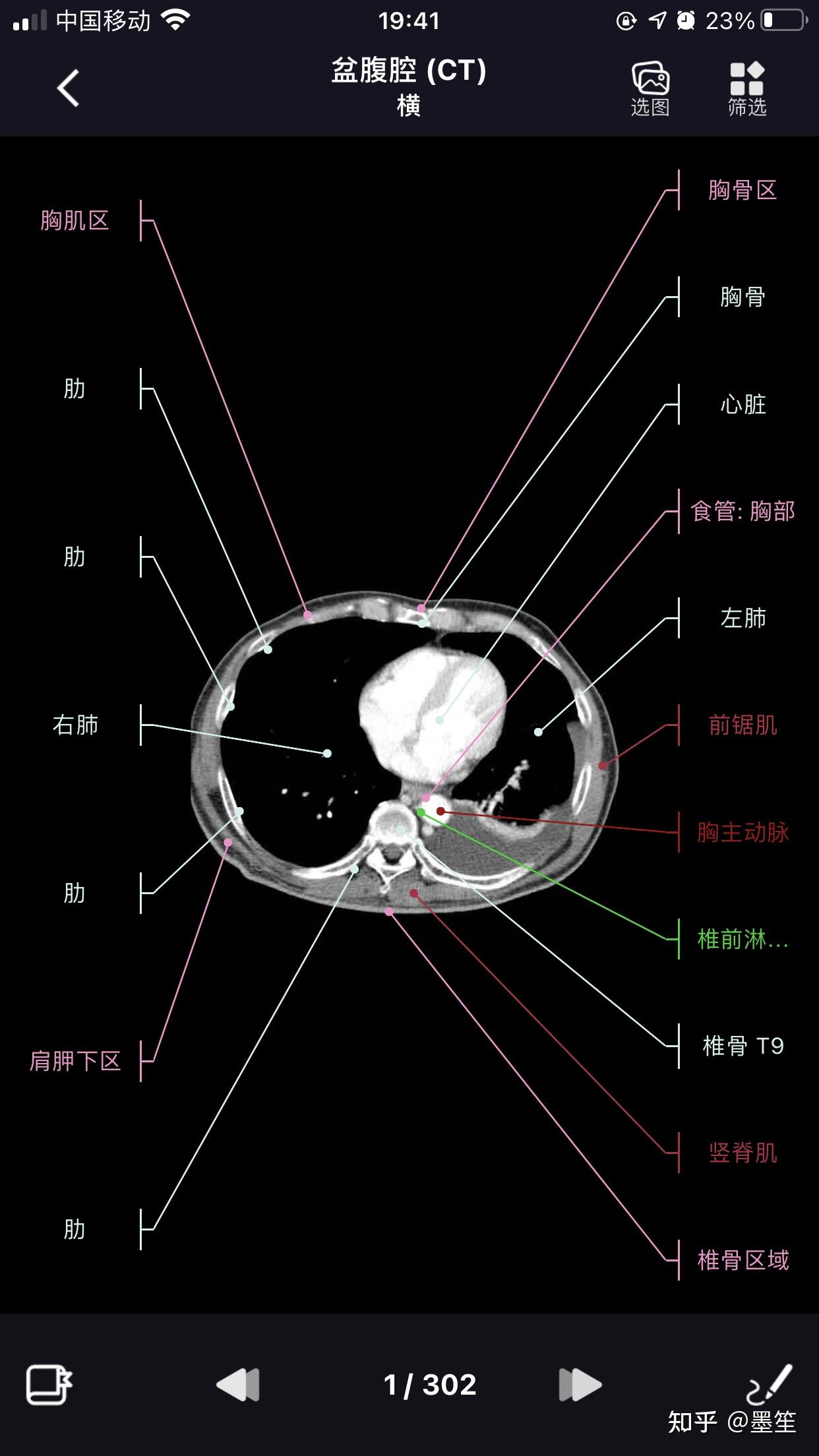 影像学习必备软件【影像解剖图谱】 - 知乎