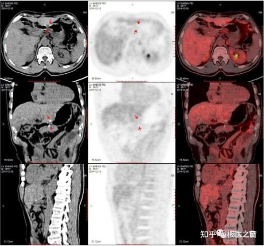 PET/CT在胃癌分期中的应用 - 知乎