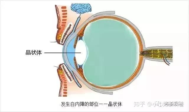 外伤性白内障术后,你的改装车需要一副懂运动的外挂镜头
