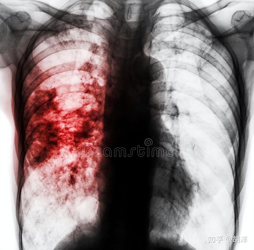 新冠患者肺部图片