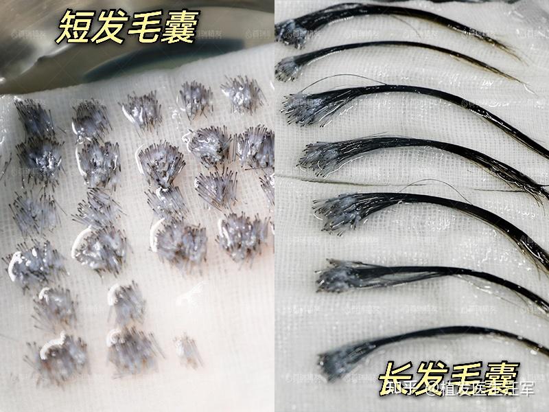 植发精微(植发经历知乎)