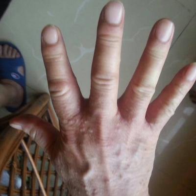 郑州皮肤科诱发疥疮的根本原因竟是这三种行为