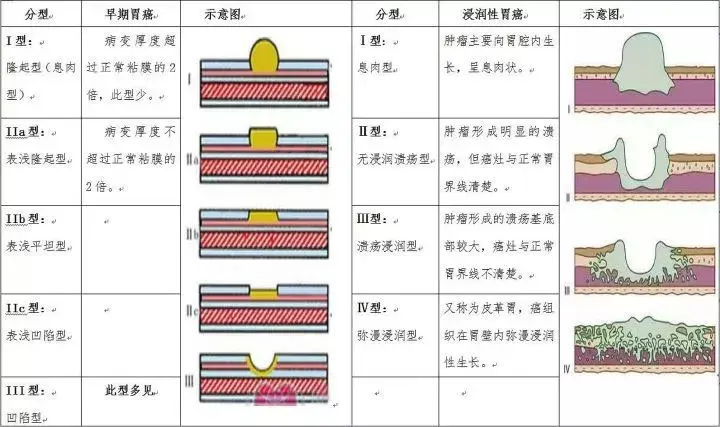 根据癌变部位的大体特征,早期胃癌,进展期胃癌分型见下表:接下来,我们