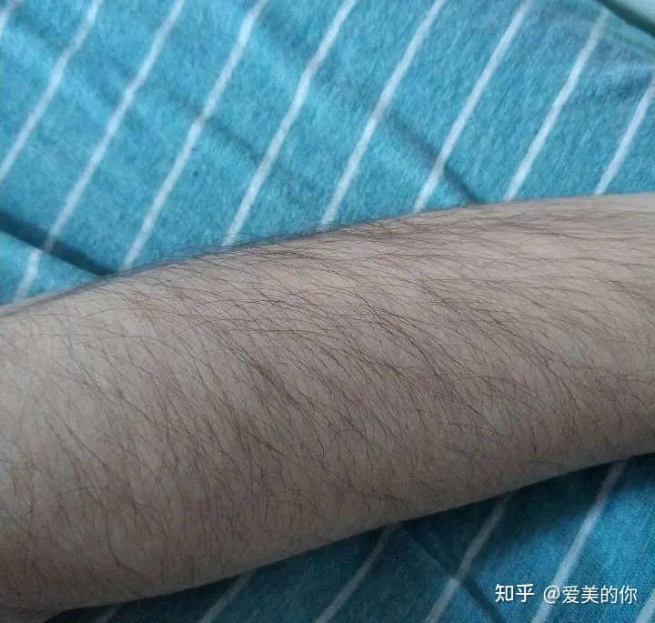 手毛太多有什么方法能脱毛