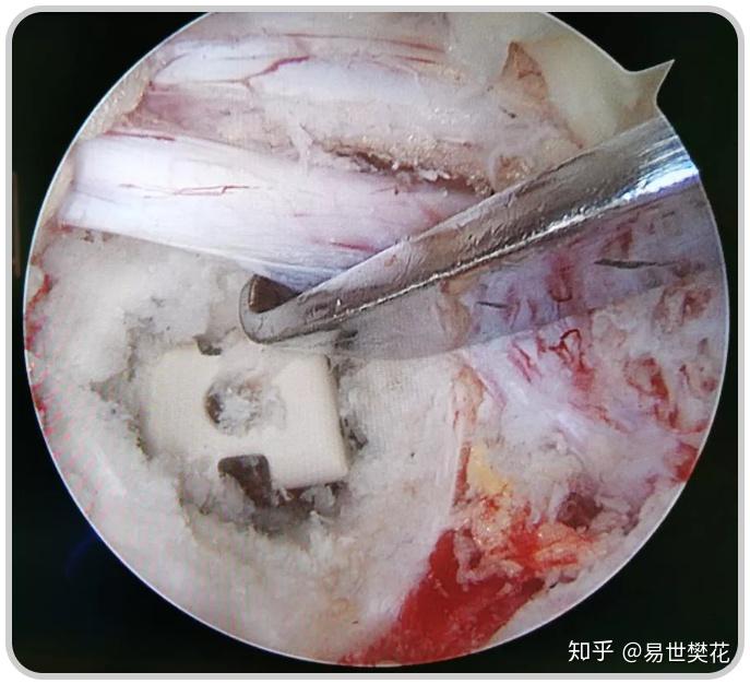 山西省人民医院张登君教授顺利开展山西省首例ube镜下融合术优选案例