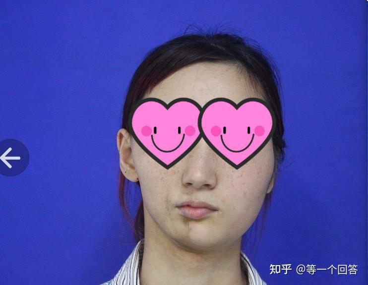 22岁罕见半面侧颜萎缩患者实现美丽变脸杭州美莱李波主任获得实名锦旗