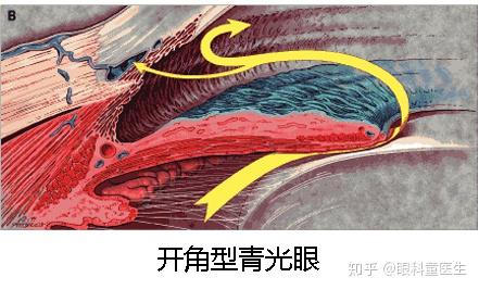 认识青光眼 - 知乎