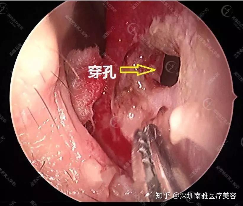 鼻中隔重建长安十二时辰热播热依扎男装打扮依然颜值在线精致的鼻子太