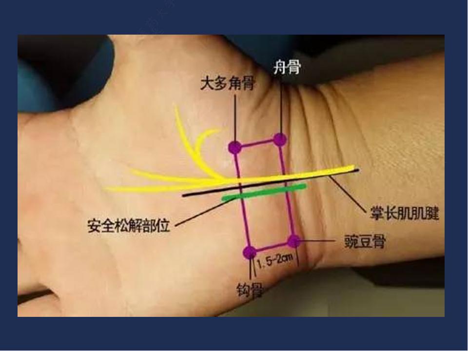 腕管综合征针刀治疗