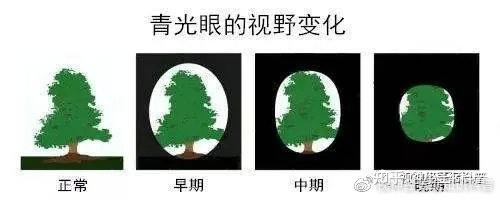 青光眼鼻侧阶梯图片