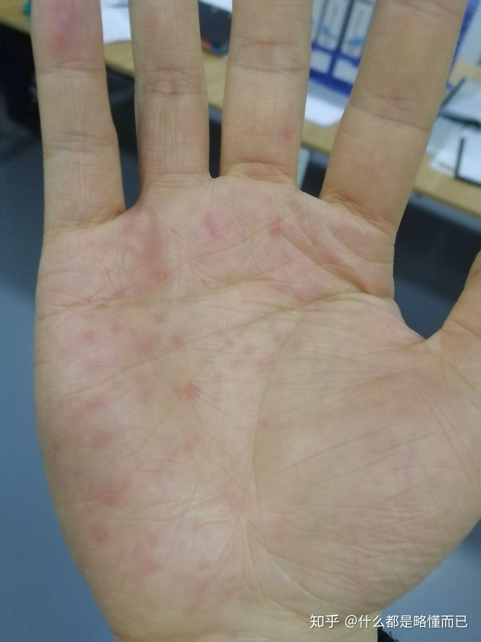 手掌出汗严重死皮长了好多红点有的时候很痒药店的人说是湿疹体内湿气