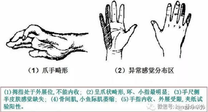 手部三大神经损伤表现 - 知乎