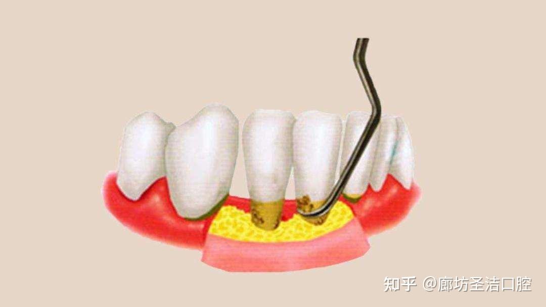 廊坊牙齦萎縮究竟還能不能恢復