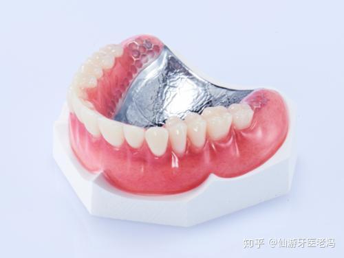 仙游种植牙 半口牙怎么镶好 详解各种假牙优缺点 知乎