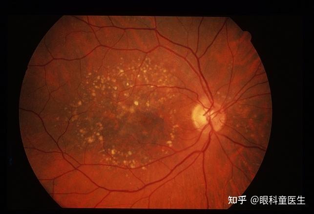 黄斑疾病——5,年龄相关性黄斑变性