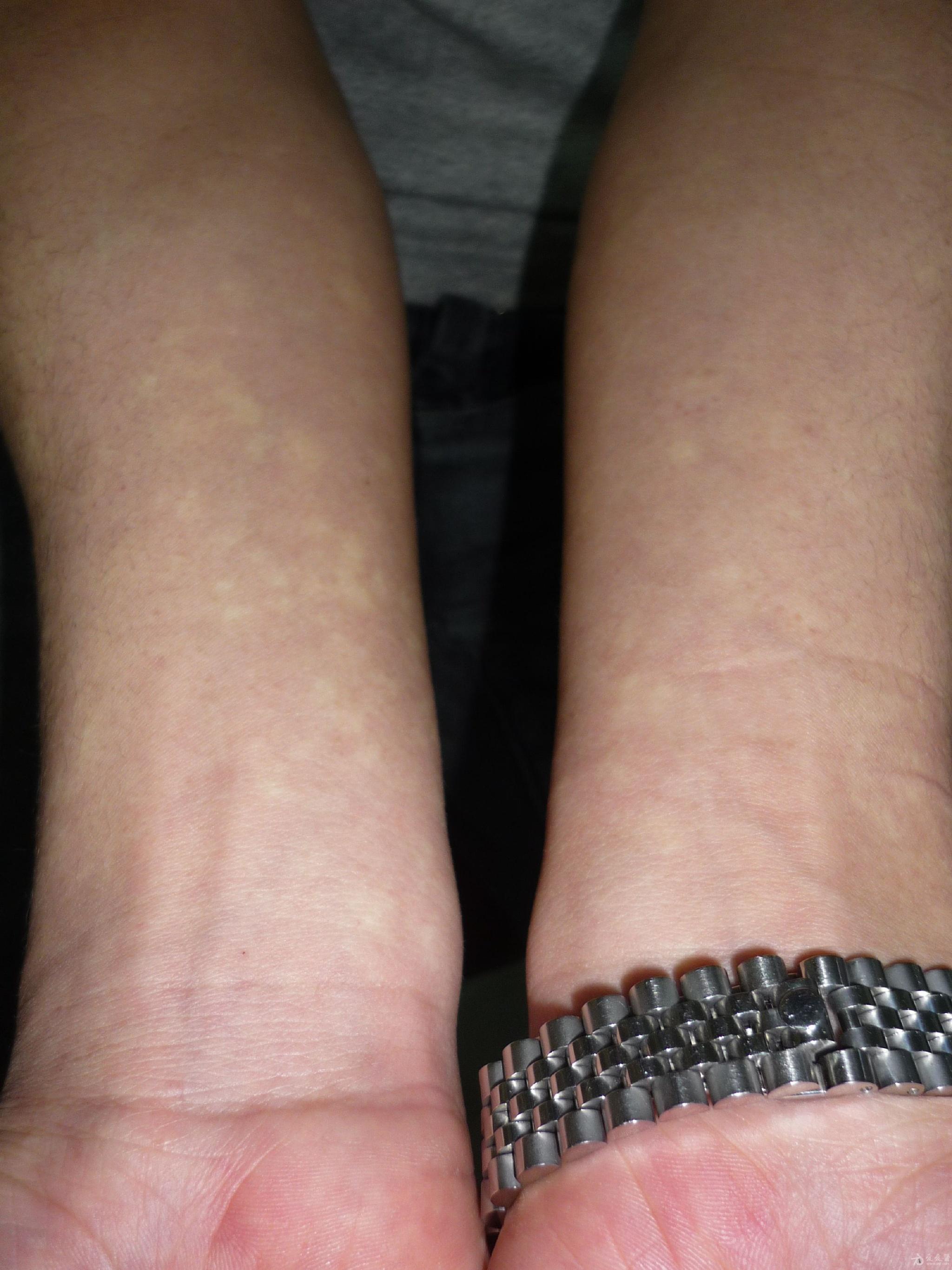 花样百出的皮肤病马歇尔怀特综合症