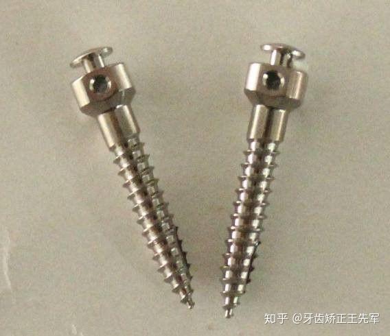 牙齿矫正为什么要打支抗钉支抗钉有什么好处