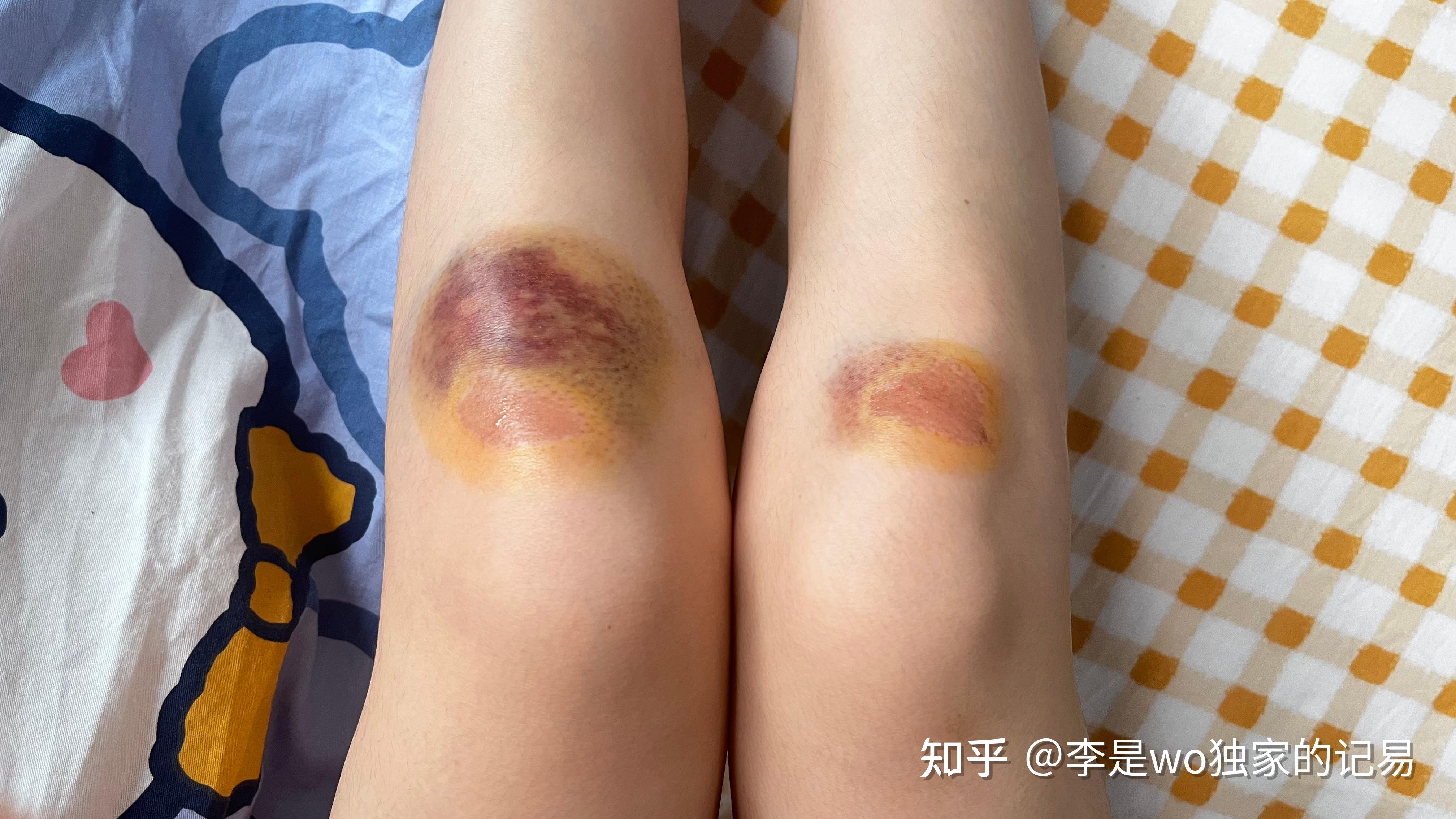 膝盖摔伤女孩子图片