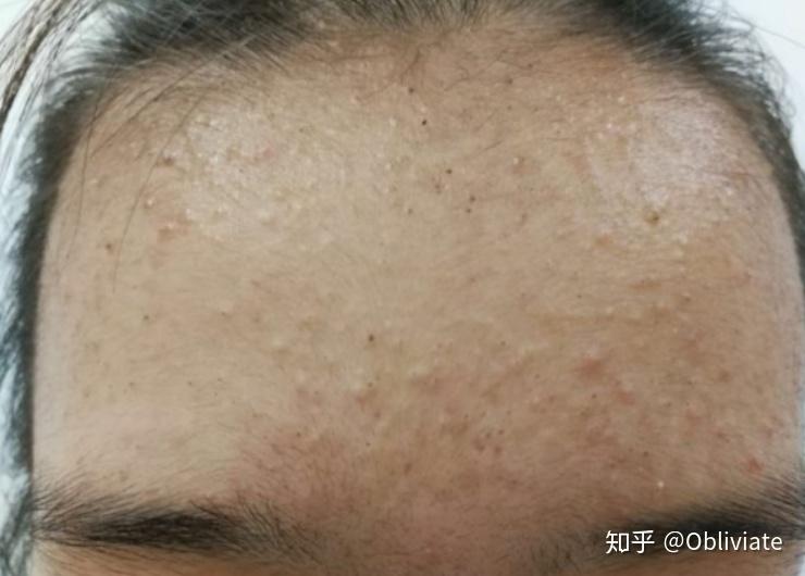 闭口可以自己消失吗?