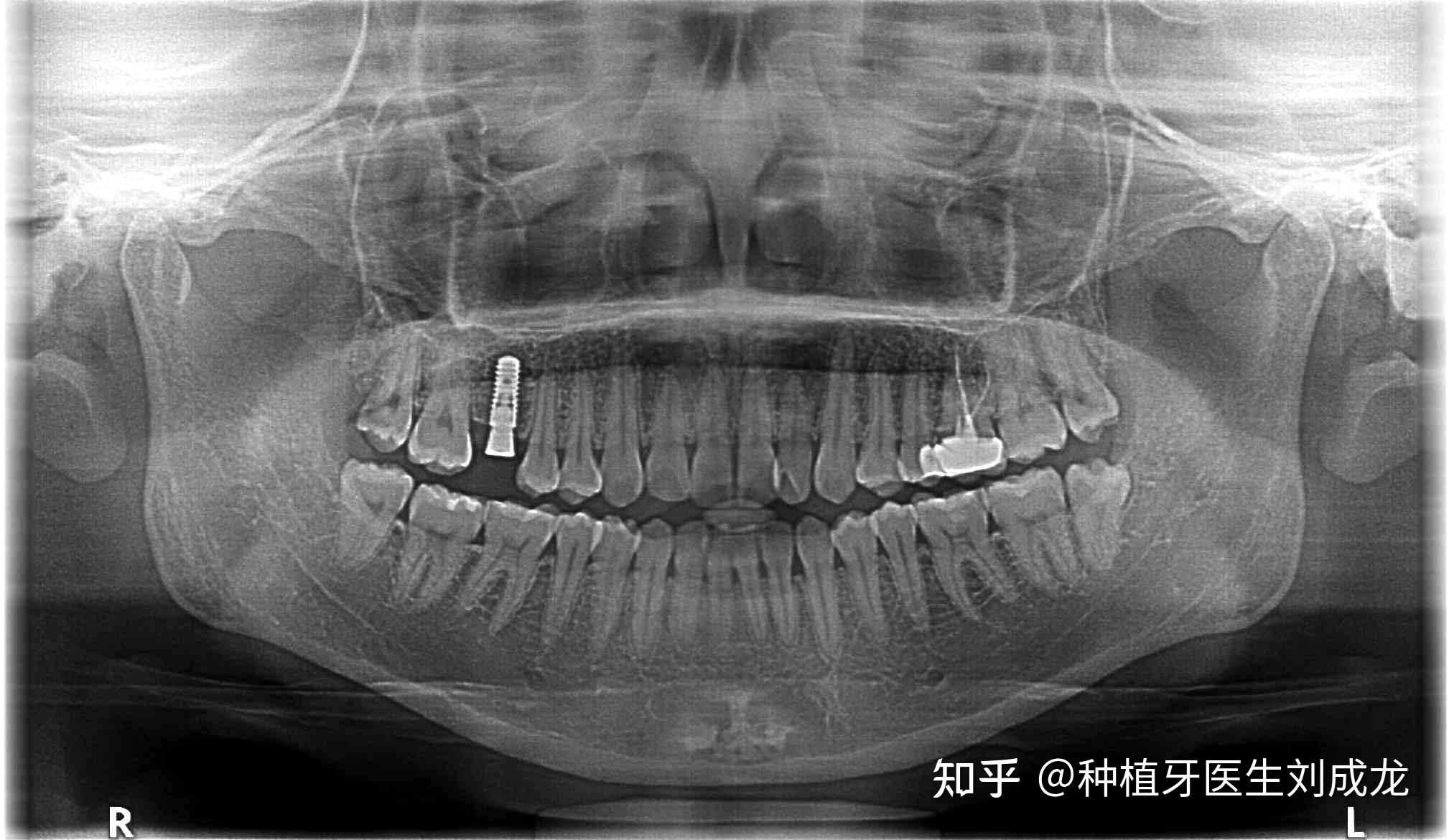 上颌6雕牙教程图解图片