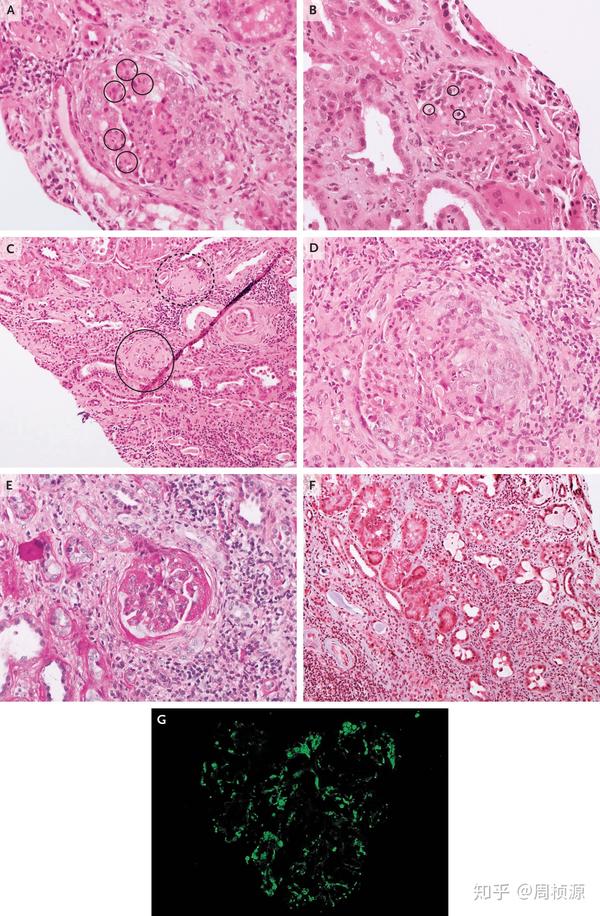 nejm 2020 case 13 知乎