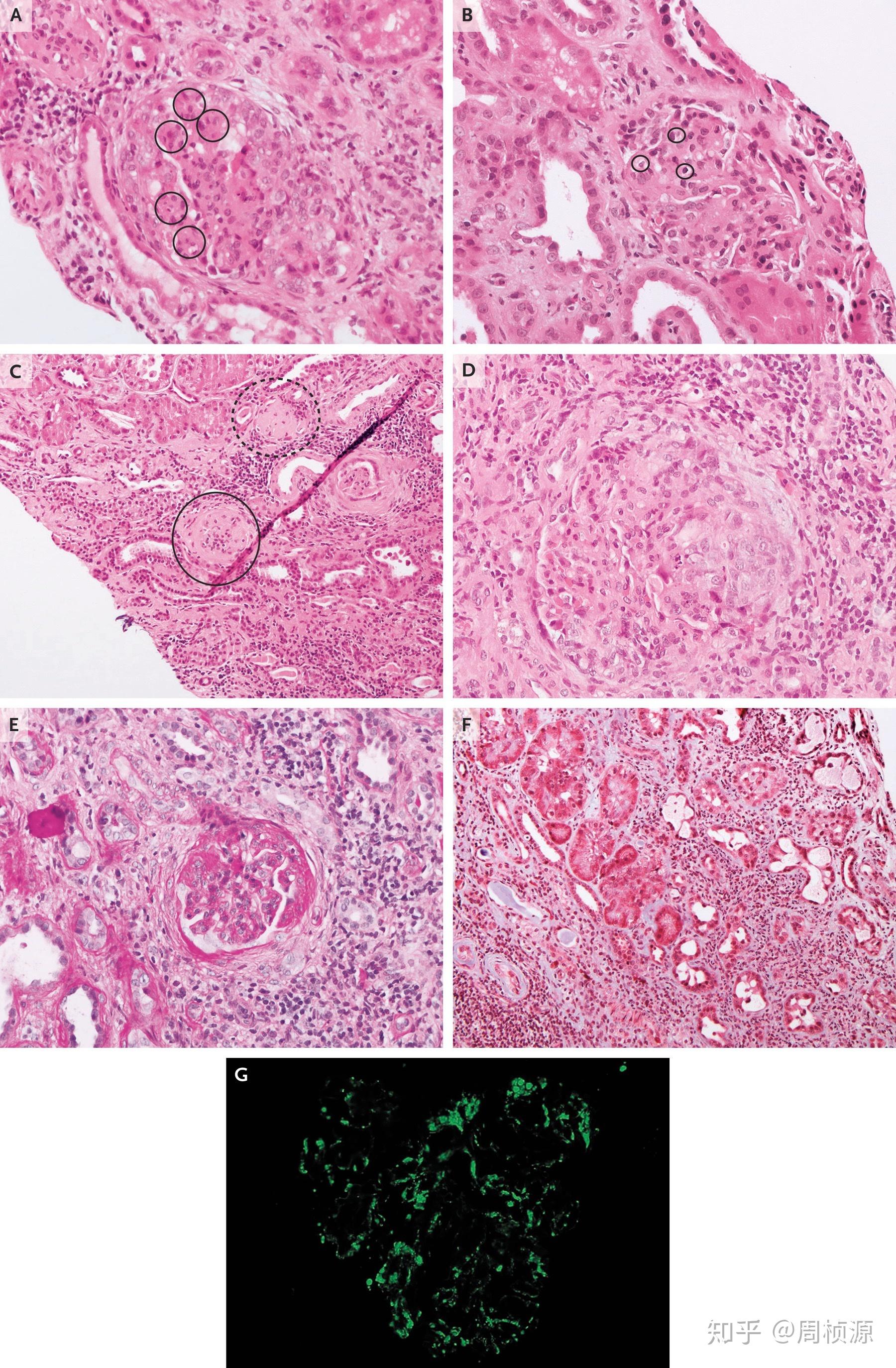下任然进入在4个月进入esrd阶段并最终接收肾移植肾脏病理证实igan