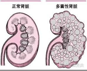 【慢病数据库】慢性肾脏病(CKD)科普 - 知乎